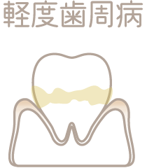 歯垢がたまり歯茎が腫れる