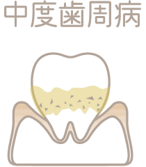 歯槽骨が溶けて後退する