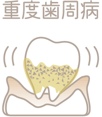 歯槽骨で歯が支えられない状態